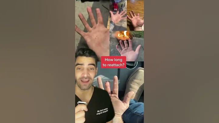 Finger Amputation and Replantation