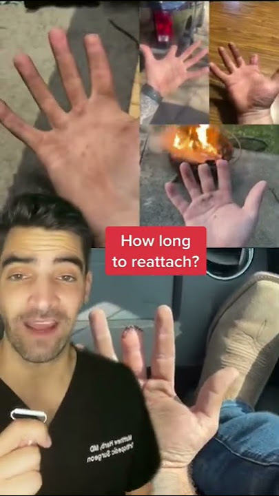 Finger Amputation and Replantation