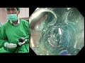 ESD, Cecal 3 cm, 17 mins