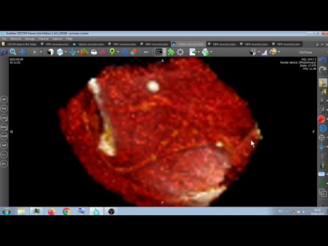 ФЛЕБОЛИТЫ . ЧТО ЭТО ?