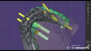 how to change direct screw retain to custom abutment while designing