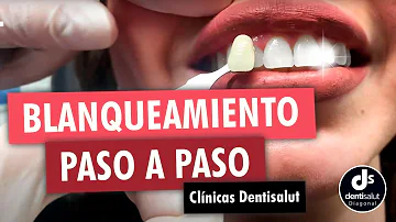 ¿Los dentistas blanquean los dientes después de la ortodoncia?