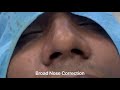 30 Minute Permanent Rhinoplasty | Broad Nose Contouring Job Video in INDIA