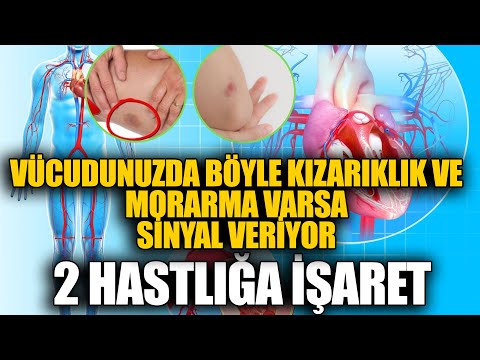 Vücudunuzda Böyle Kızarıklık ve Morarma Varsa Sinyal Veriyor. 2 Hastlığa İşaret.