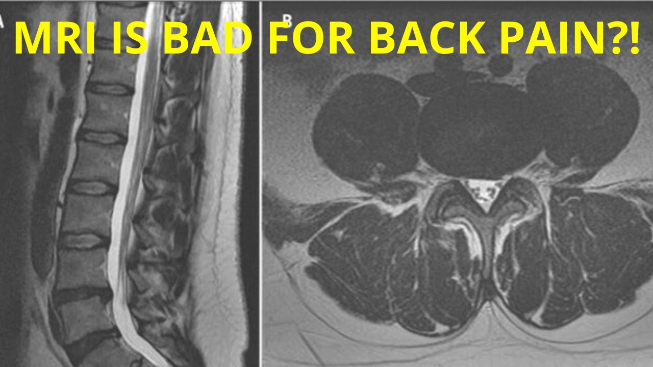 Can An MRI Cause Lower Back Pain Research Findings YouTube Can An MRI Cause Lower Back Pain Research Findings YouTube