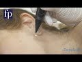 FreezPen Cryotherapy - Training  Video 1