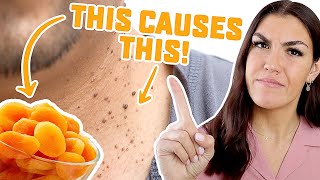 Stop Eating These 5 'Healthy' Foods That Cause Skin Tags! (Acrochordons)
