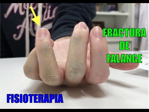 Vídeo: Fractura De La Falange Del Dedo: ¿cómo Desarrollar Un Dedo Después De Una Fractura?