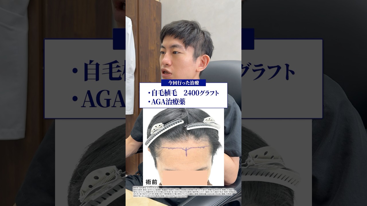 Case Study] Successfully lowered the hairline with a hair