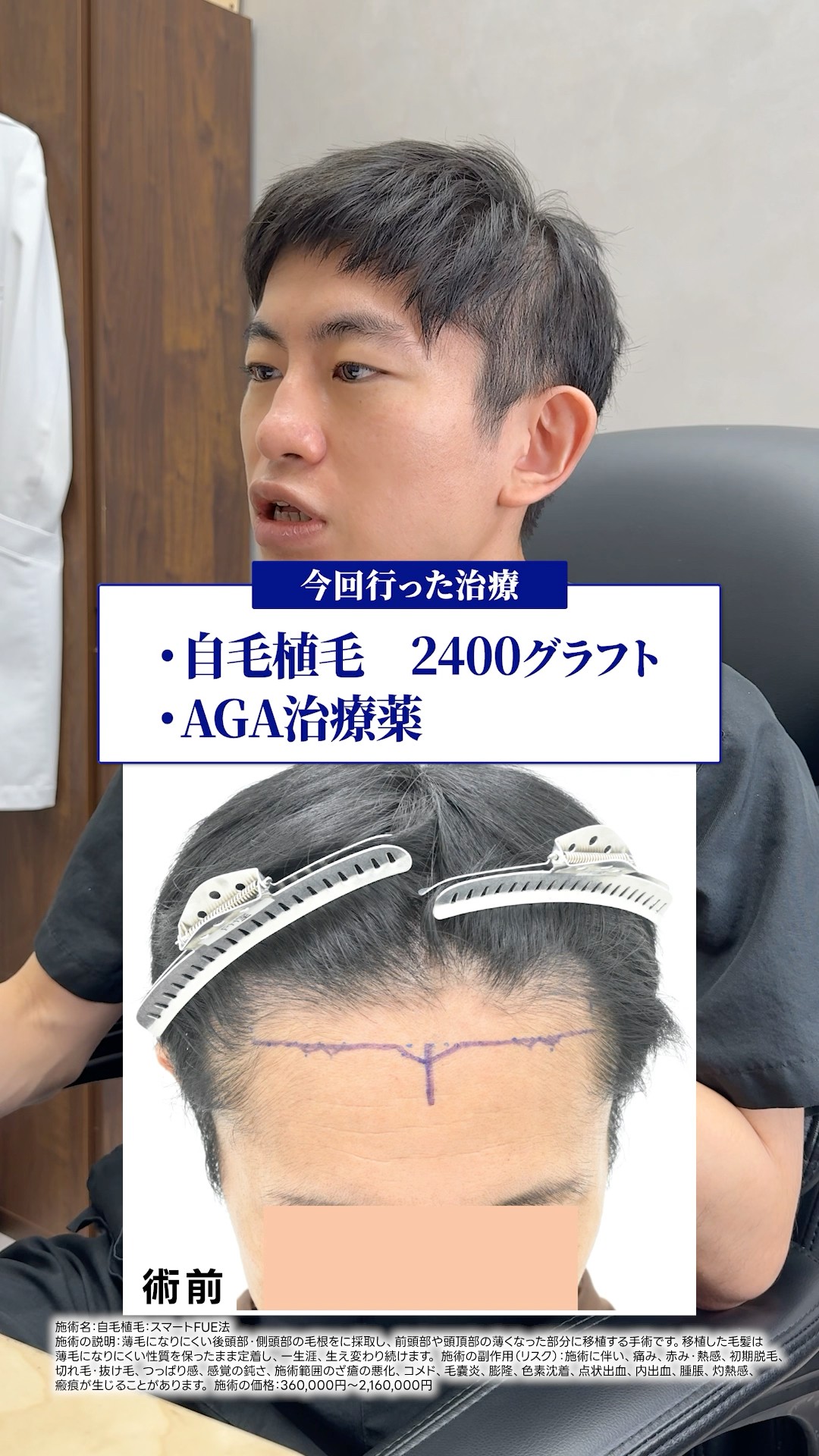 Case Study] Successfully lowered the hairline with a hair