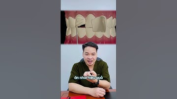 Dán sứ veneer giải pháp lý tưởng cho răng cửa mẻ #DrThu #BsThu