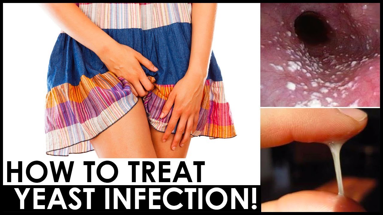 HOW TO USE COCONUT OIL FOR YEAST INFECTION 😍 HOW TO GET