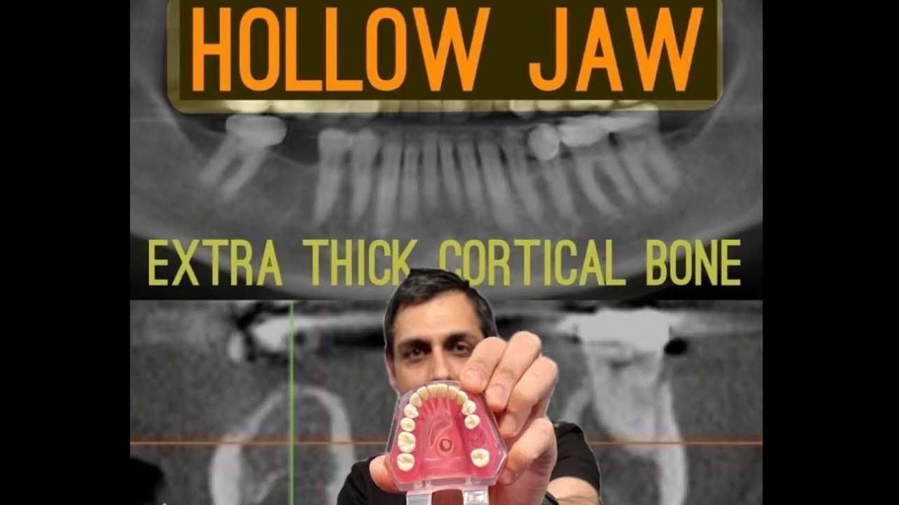 Focal Osteoporotic Bone Marrow Defects that can Sabotage your Dental