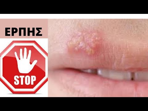 Βίντεο: Πώς να αντιμετωπίσετε ένα κομμένο χείλος (με εικόνες)