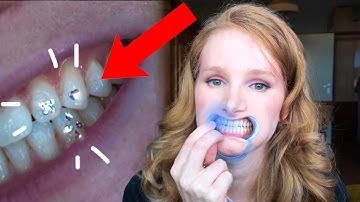 DIY Tooth Gems Zetten!