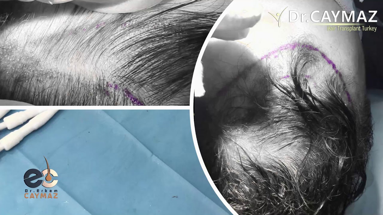 DHI - CHOI PEN - UNSHAVEN OPERATION