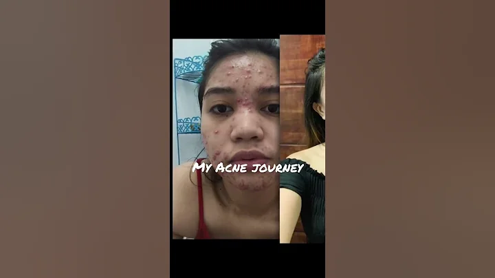 My Acne Journey #acne #pimpleproblem #skincare #journey #acnetreatment #acnescars