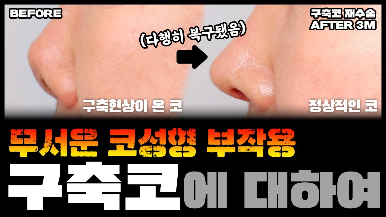 무서운 코성형부작용 구축코 현상!!! 코성형 생각중인 분들이라면 꼭 보세요!!!! #구축코 #코성형부작용 #구축코예방