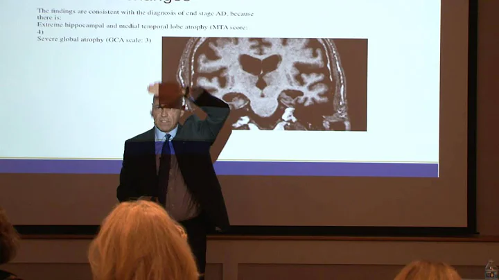 Dr. Bludau's Lecture on Alzheimer's Disease & Othe...