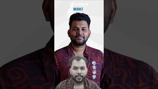 ഹെയർ ട്രാൻസ്പ്ലാന്റ് സർജറി: 7 മാസത്തെ റിസൾട്ട് - ലാ ഡെൻസിറ്റെ ക്ലിനിക്ക് കൊച്ചി