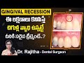 చిగుళ్లలో ఈ సమస్య | Gum Problem Solution in Telugu | Gingival Recession | Eledent Dental Hospitals