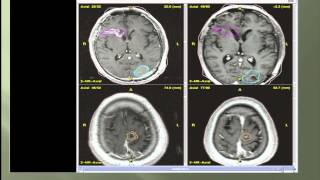 Are There New Techniques in Radiation Therapy that Offer Me Treatment Options?