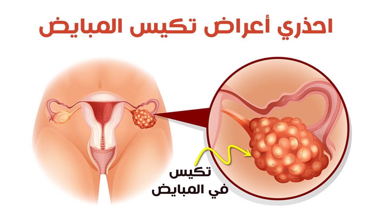 Image result for ‫تكيس المبايض‬‎