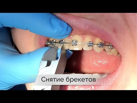 Снятие брекетов | брекеты Самара влог | braces off