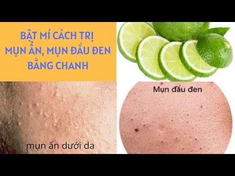 Bật mí cách trị mụn ẩn, mụn đầu đen bằng chanh| Thanh Vũ