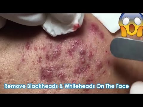 How To Remove blackheads On The Face Easy Acne Treatment #