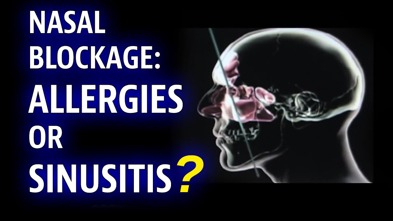 Symptoms & Causes of Nasal Allergies Michael Gatto, MD YouTube