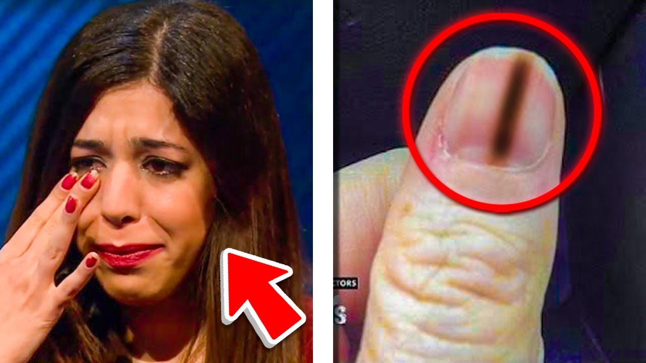 Doctors Warn Of Potentiall Deadly Form Of Nail Cancer - YouTube