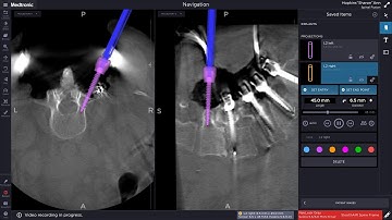 Christopher P. Silveri, M.D.- O-Arm Surgical Navigation of Lumbar Pedicle Screw Trajectory.