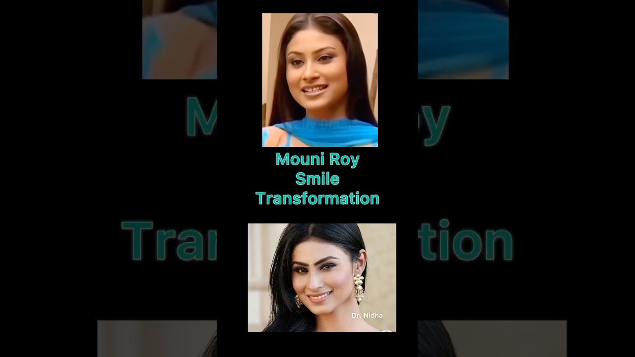 Mouni Roy Smile Transformation 