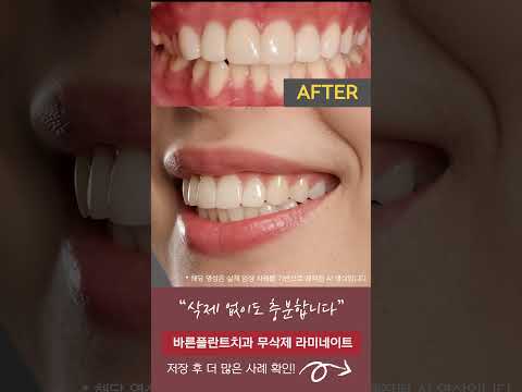 치아 삭제가 걱정된다면, 무삭제 라미네이트 가능 여부부터 확인하세요 ✨ #망우동치과 #망우역치과 #중랑구치과 #라미네이트