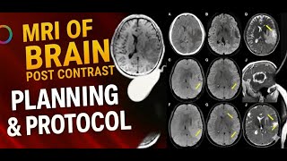 MRI of Brain with Post-Contrast | Planning, Protocol & Positioning