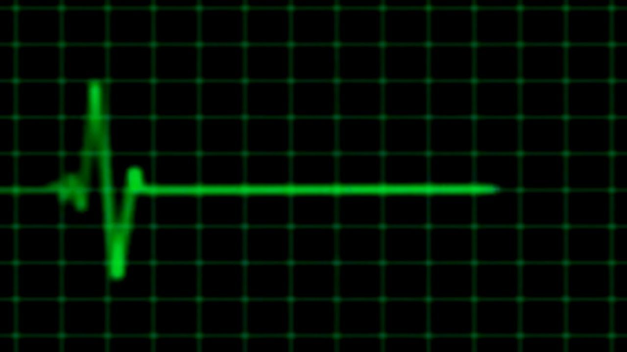 Звук остановки времени. Кардиограмма остановки сердца. Кардиограмма смерти. Остановка сердца анимация. Гиф остановка сердца на кардиограмме.