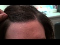 Female Hairline Lowering Results Close Up via Hair Transplant in Dallas, Texas