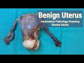 Benign uterus  anatomical pathology grossing review series
