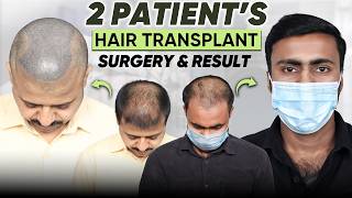 Hair Transplant in Chennai (HX-YFVD) | Best Results & Cost of Hair Transplant in Chennai