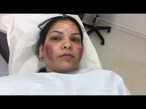 Micro needling| Acne scar treatment| Last Sitting Vlog| Day 