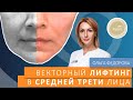 Векторный лифтинг в средней трети лица с препаратом Radiesse