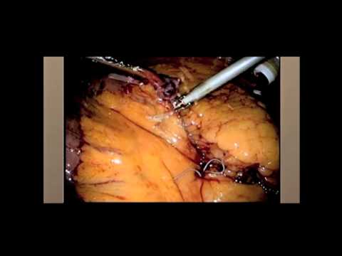 Marginal Ulceration and Strictures after Roux-en-Y Gastric Bypass | Conditions Requiring Attention
