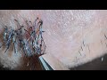 Plucking facial hair 1301 顎髭抜き