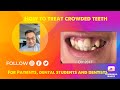 How to fix your crowded teeth with braces by loc huynh dds dmd