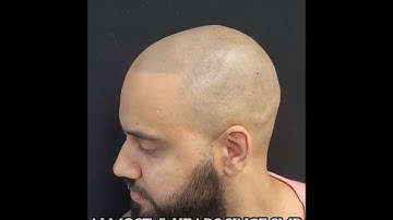 5 year old  SMP. Line up hairline.  Before /After  Touch up.