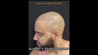 5 year old  SMP. Line up hairline.  Before /After  Touch up.