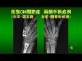 母指CM関節症　両側手術症例（固定術・形成術）