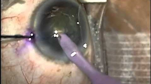 Phaco Supracapsular Flip Carousel, Dennis Lu, M.D. 01/06/14