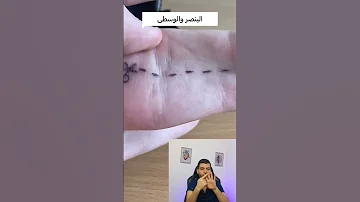 إلتصاق الأصابع الاصبع الاصابع التصاق التصاقات وراثي جراحي الوسطى د مصعب حسوا ثقف نفسك طبيا 